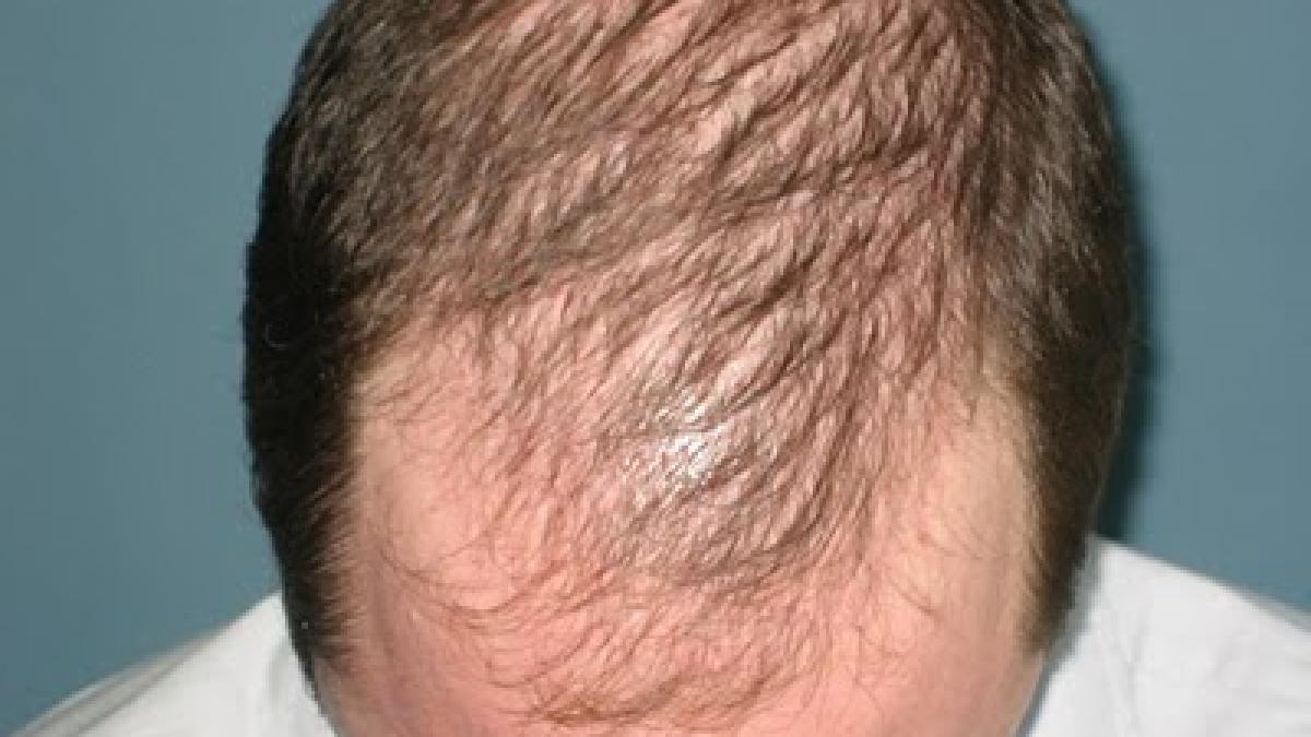 studiu calvitia precoce un posibil indiciu pentru depistarea cancerului la prostata