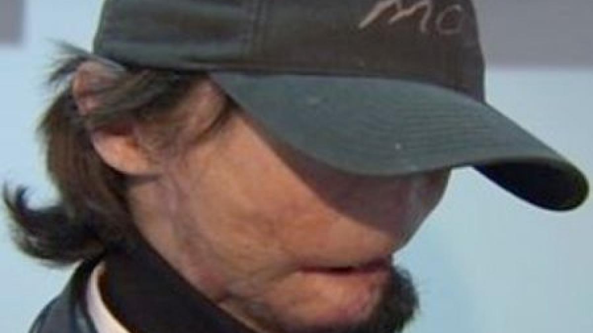 imagini socante primul transplant total de fata din sua