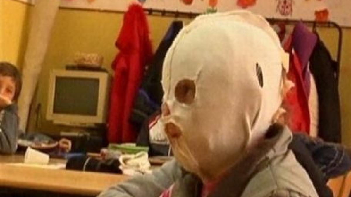 o fetita de 10 ani cu fata arsa trebuie sa poarte o masca de plastic tot timpul