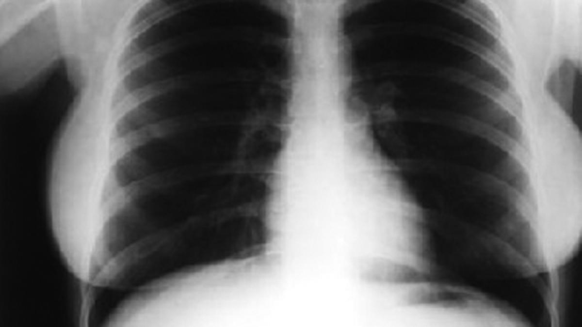 organele unei fetite care a murit intr un accident vor salva doua vieti