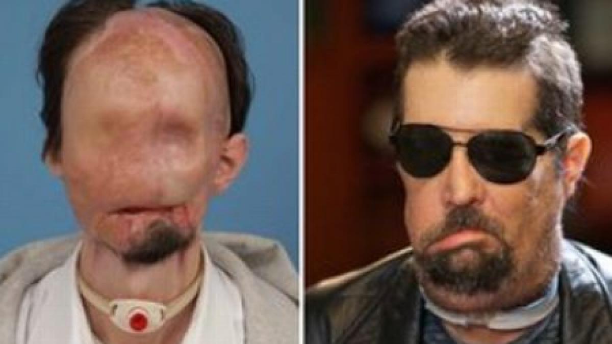 primul american cu transplant total de fata si a aratat noua infatisare