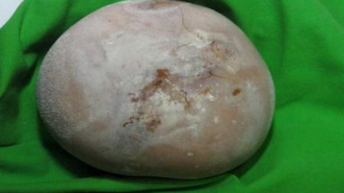 piatra de aproape un kilogram scoasa din vezica urinara a unui barbat din dolj