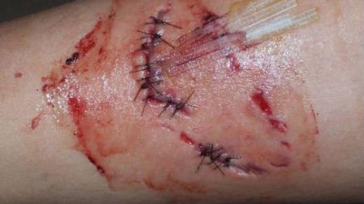 iasi o femeie a fost muscata de sotul si fiica ei in urma unui scandal in familie