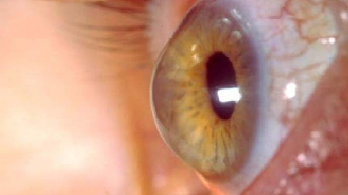 keratoconul boala care distruge corneea apare mai des la cei cu lentile contact si alergii oculare