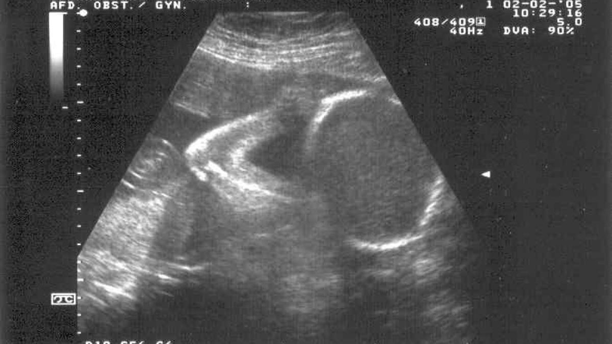 consiliul european vrea sa le interzica medicilor sa dezvaluie parintilor sexul copiilor inainte de