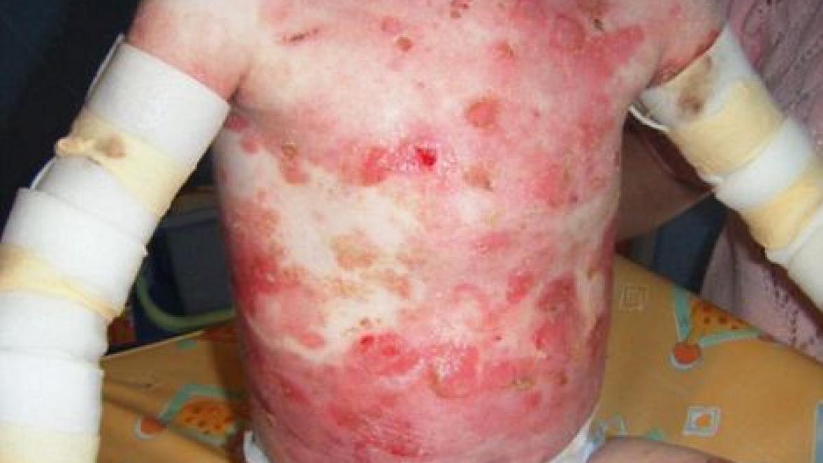 boala care il tine departe de dragoste povestea baietelului care nu poate fi imbratisat