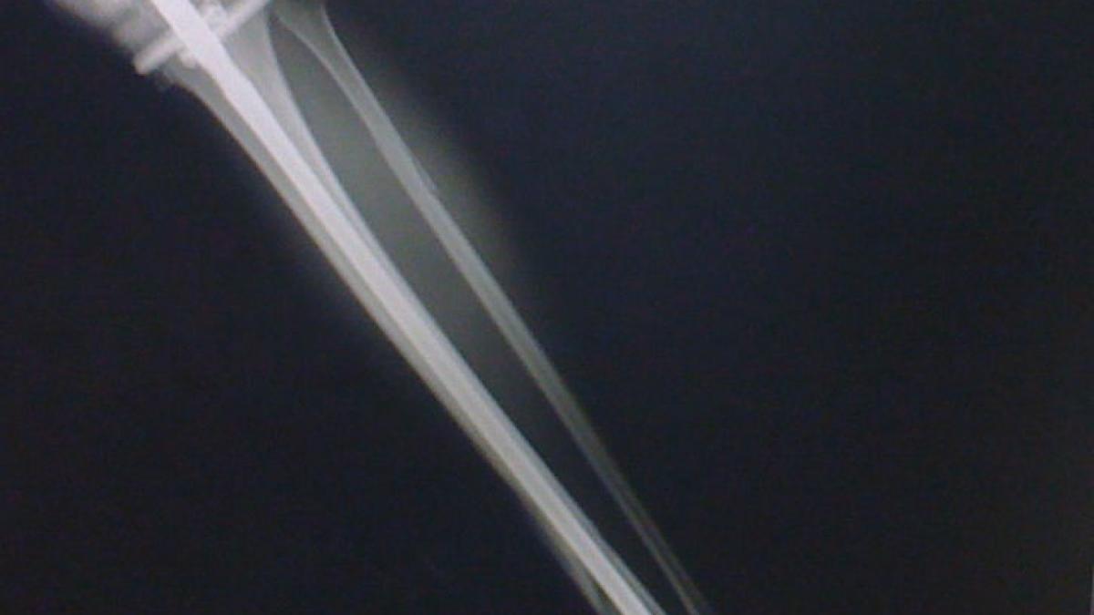 un medic din vaslui acuzat ca a uitat mai multe pansamente in piciorul unui tanar