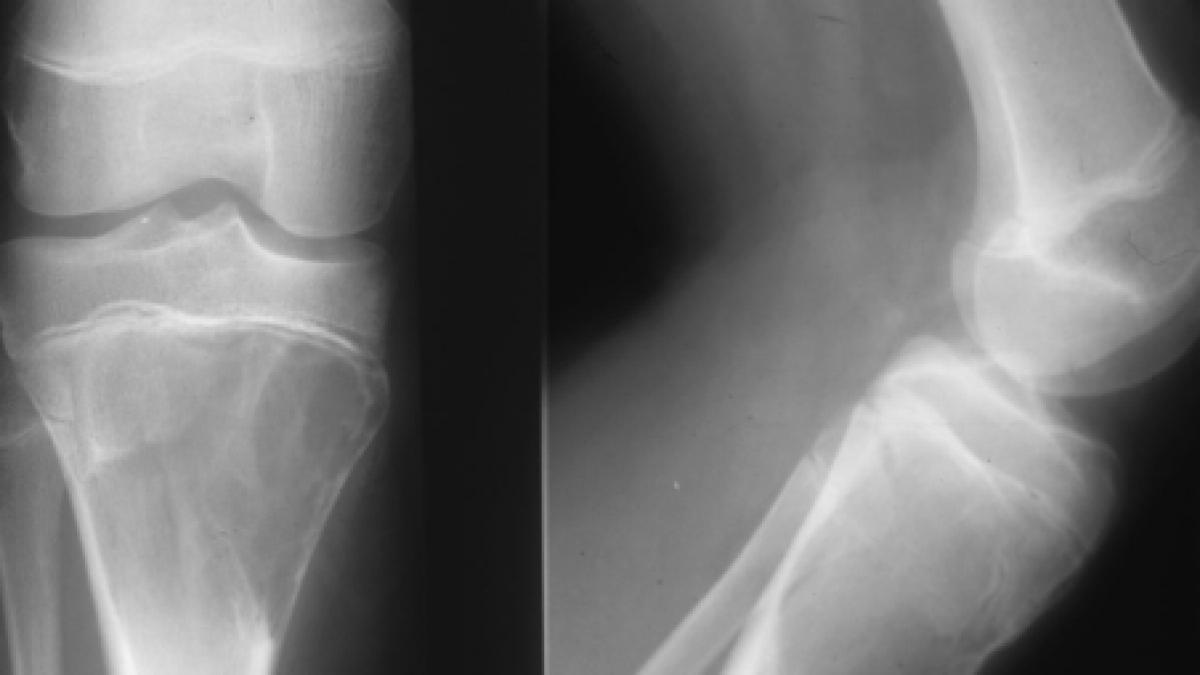 boala oaselor de sticla o fetita de 7 ani sufera de o boala extrem de rara