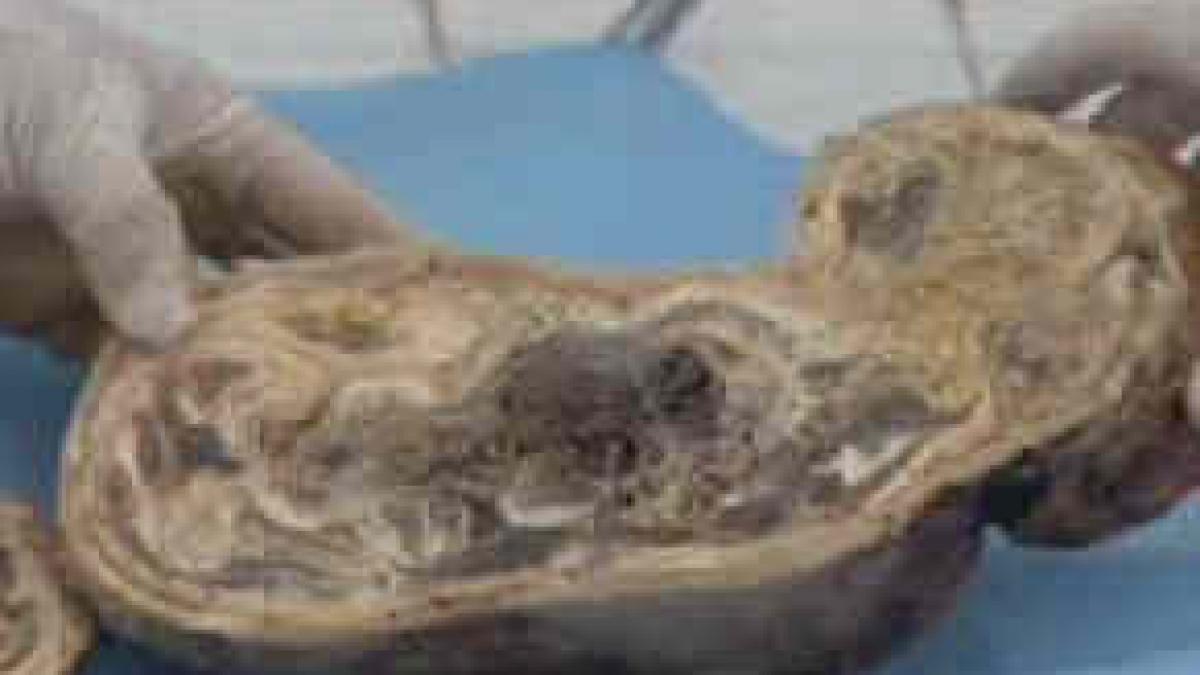 a dat nastere unei mumii vezi un top cu cele mai socante cazuri medicale