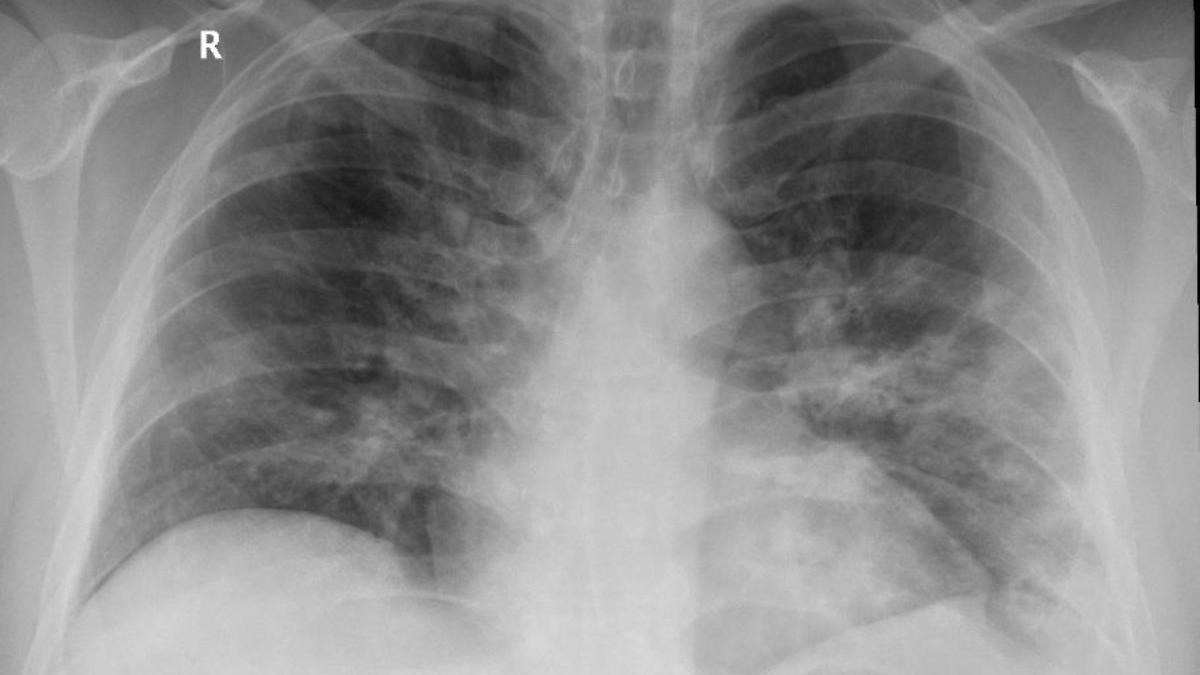 pericol de epidemie o educatoare din iasi depistata cu tuberculoza