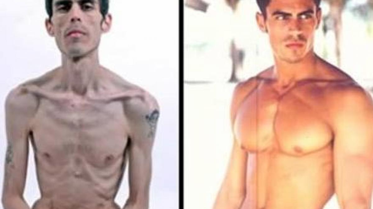 cel mai sexy barbat a murit din cauza anorexiei cazuri socante care au cutremurat lumea