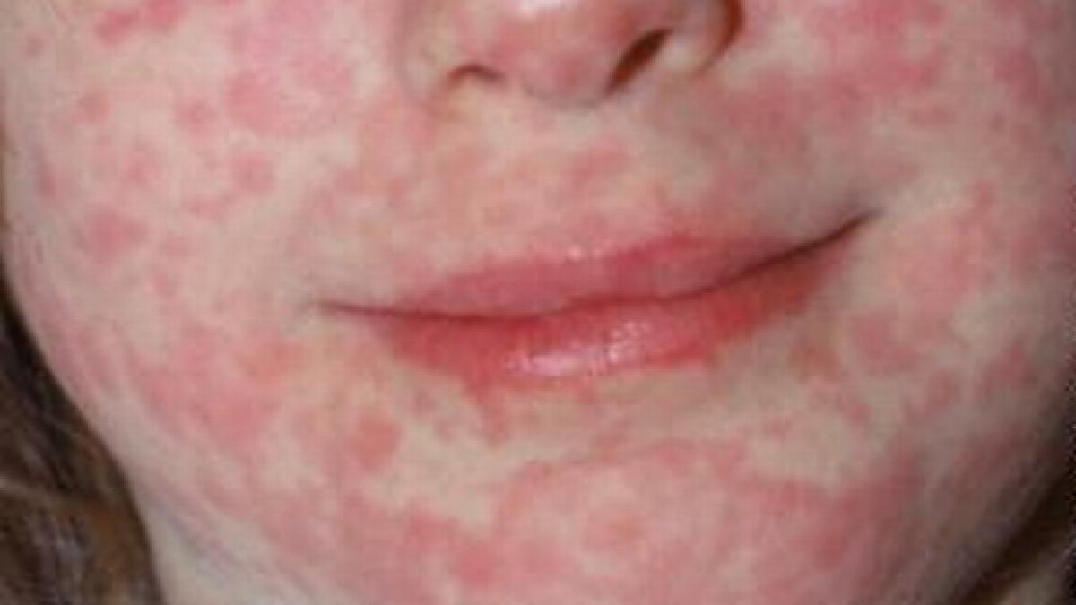 numarul bolnavilor de pojar de 15 ori mai multe decat anul trecut