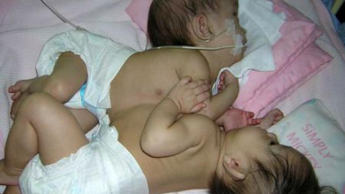 doua fetite siameze lipite in zona toracelui s au nascut la maternitatea din pitesti bebelusii in