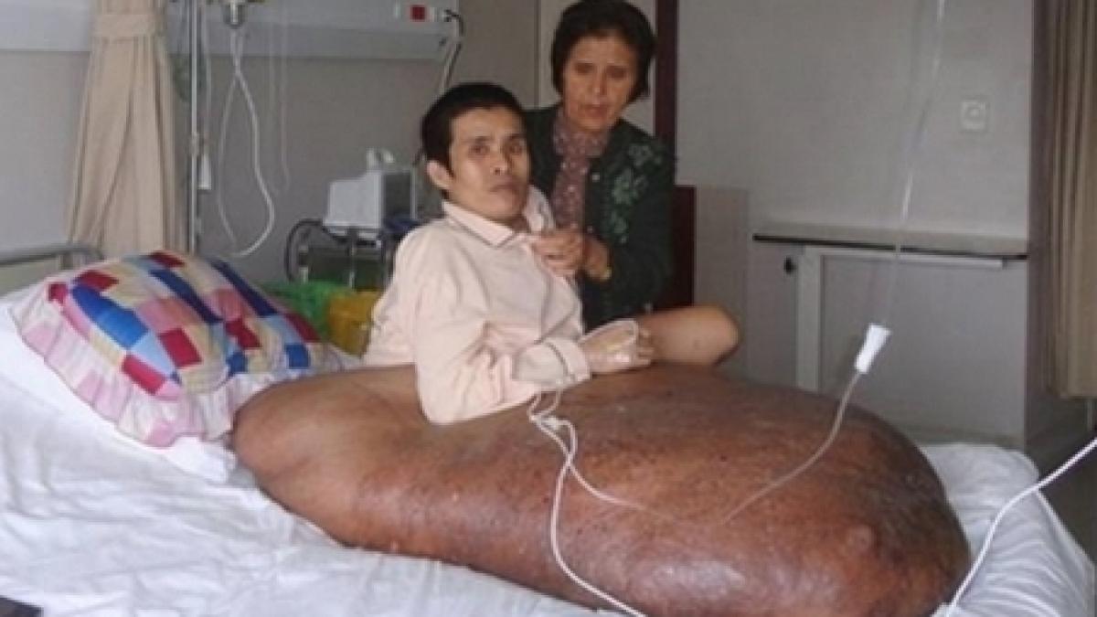 tumoare de 90 kg si diametrul de un metru barbatul va fi operat astazi