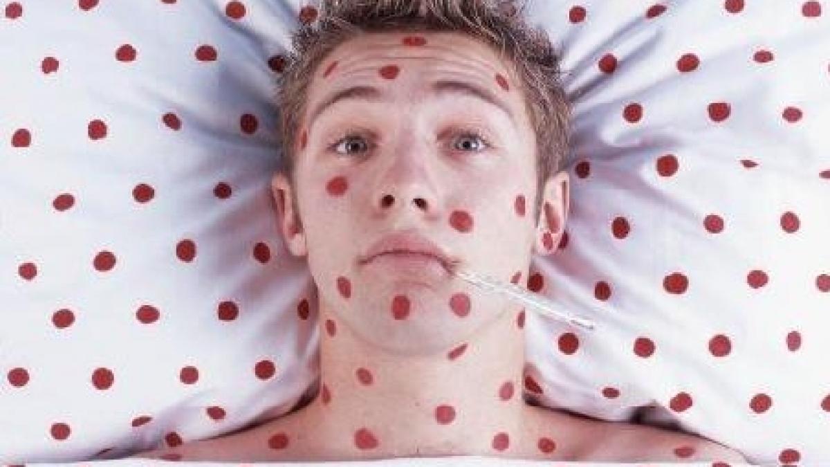 135 de cazuri de rubeola inregistrate in suceava majoritatea in colegii si licee