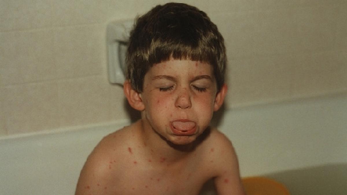 epidemie de rubeola in judetul sibiu peste 300 de cazuri inregistrate in 12 licee