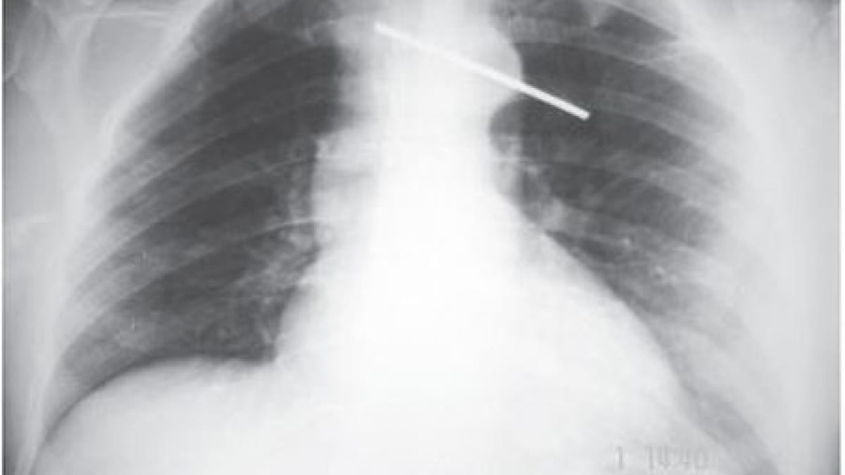 medicii botosaneni au descoperit in corpul unei batrane o tija metalica de 20 cm