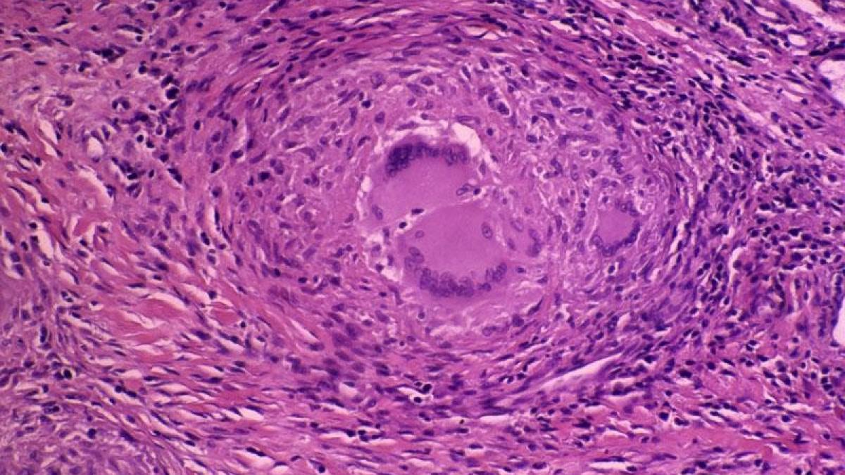 lumea medicinei revolutionata de un vaccin viata a milioane de oameni va fi salvata