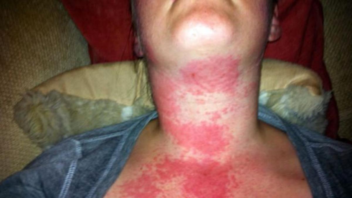 parea arsa pe gat si fata dupa ce a vorbit la iphone imaginile care i au socat pe medici