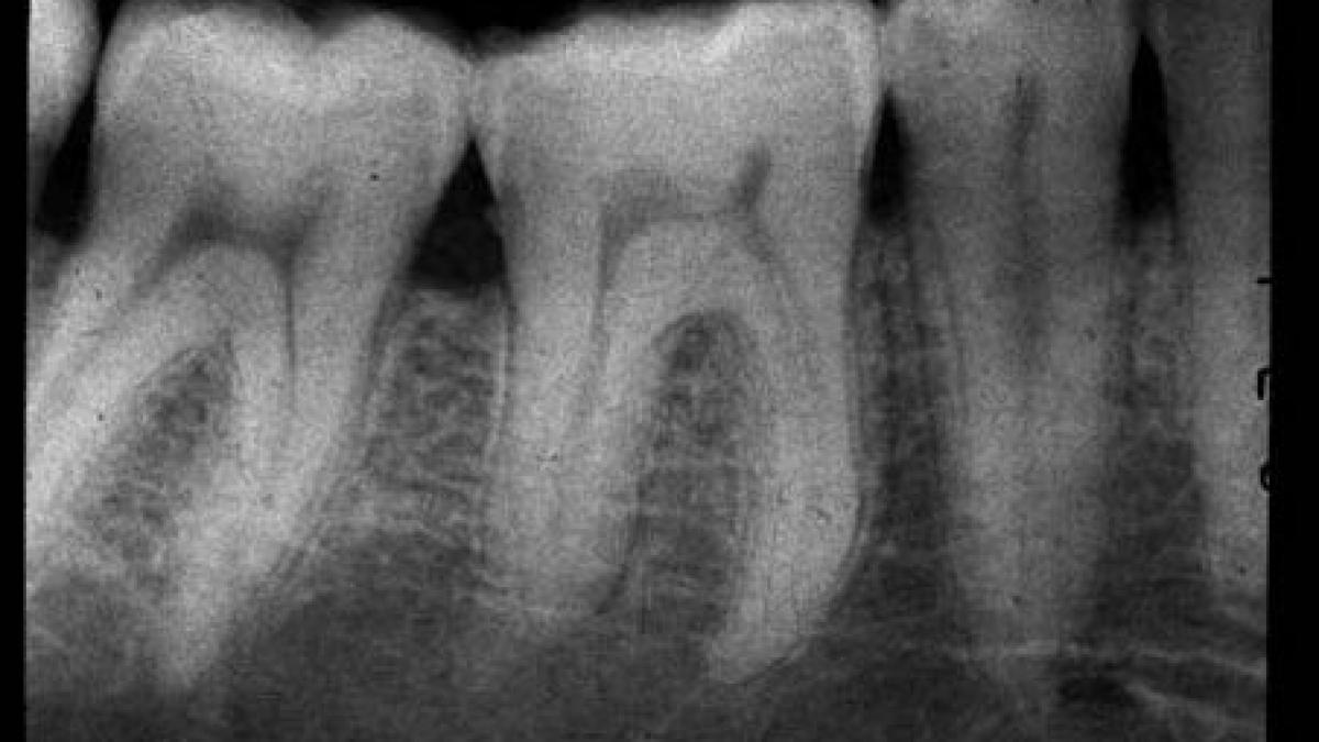 radiografiile dentare cresc riscul dezvoltarii tumorilor cerebrale