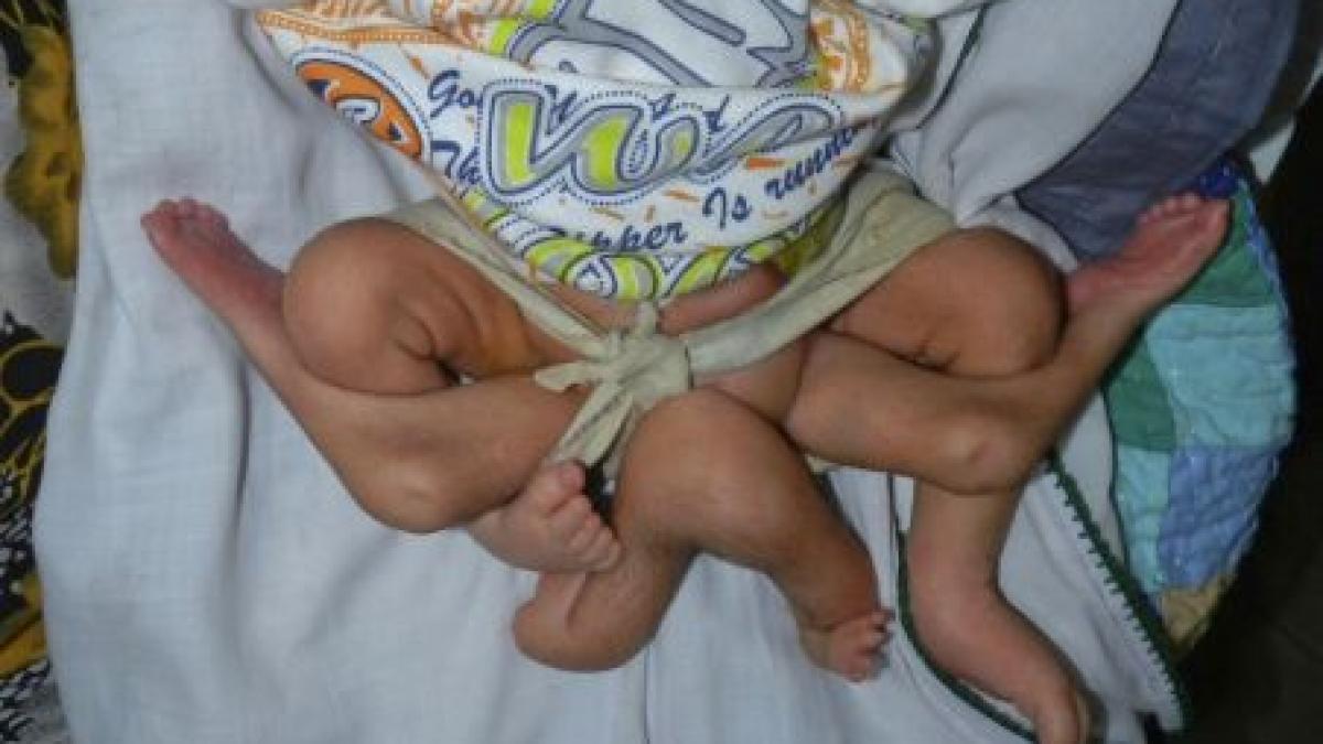 un copil s a nascut cu sase picioare medicii pakistanezi incearca sa i salveze viata