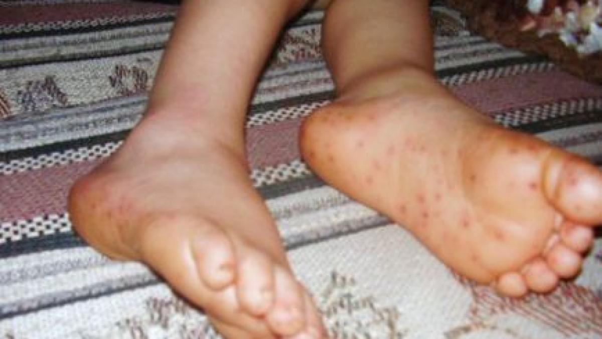 boala misterioasa care ii ucide pe vietnamezi organizatia mondiala a sanatatii in alerta