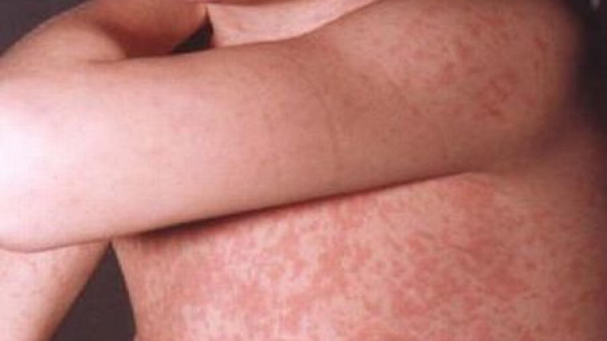 epidemie de rubeola in tara la sibiu s au inregistrat de 30 de ori mai multe cazuri decat anul