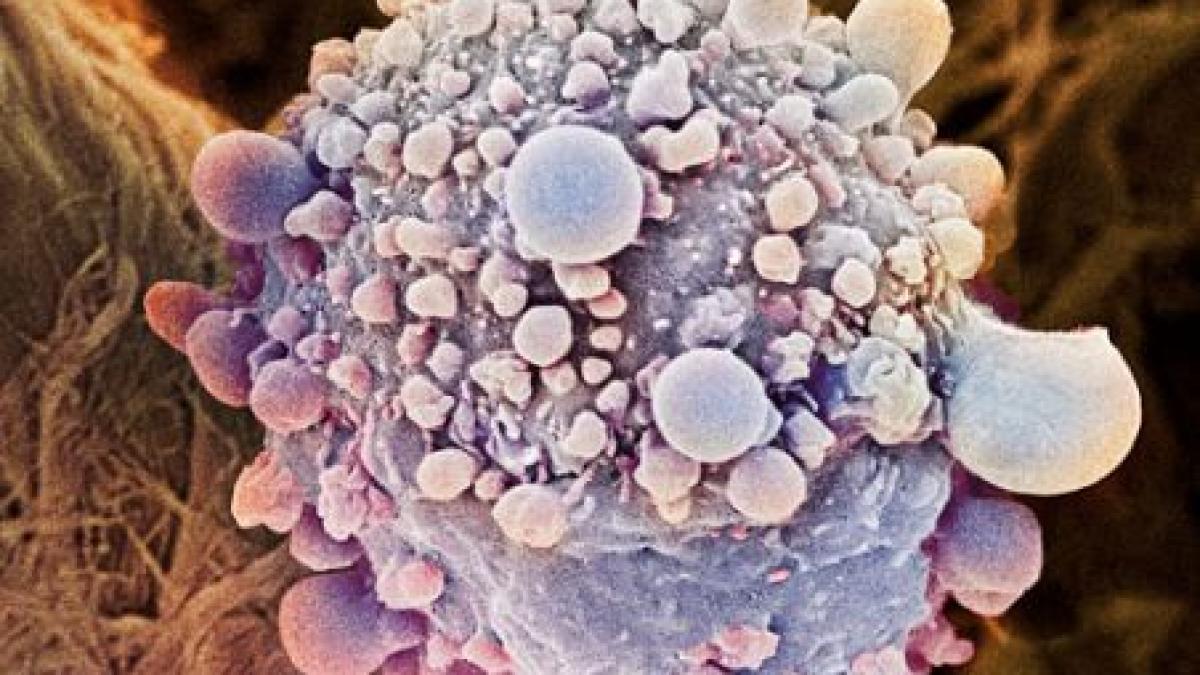 extinderea cancerului pancreatic poate fi stopata o gena inactiva cheia intregului proces