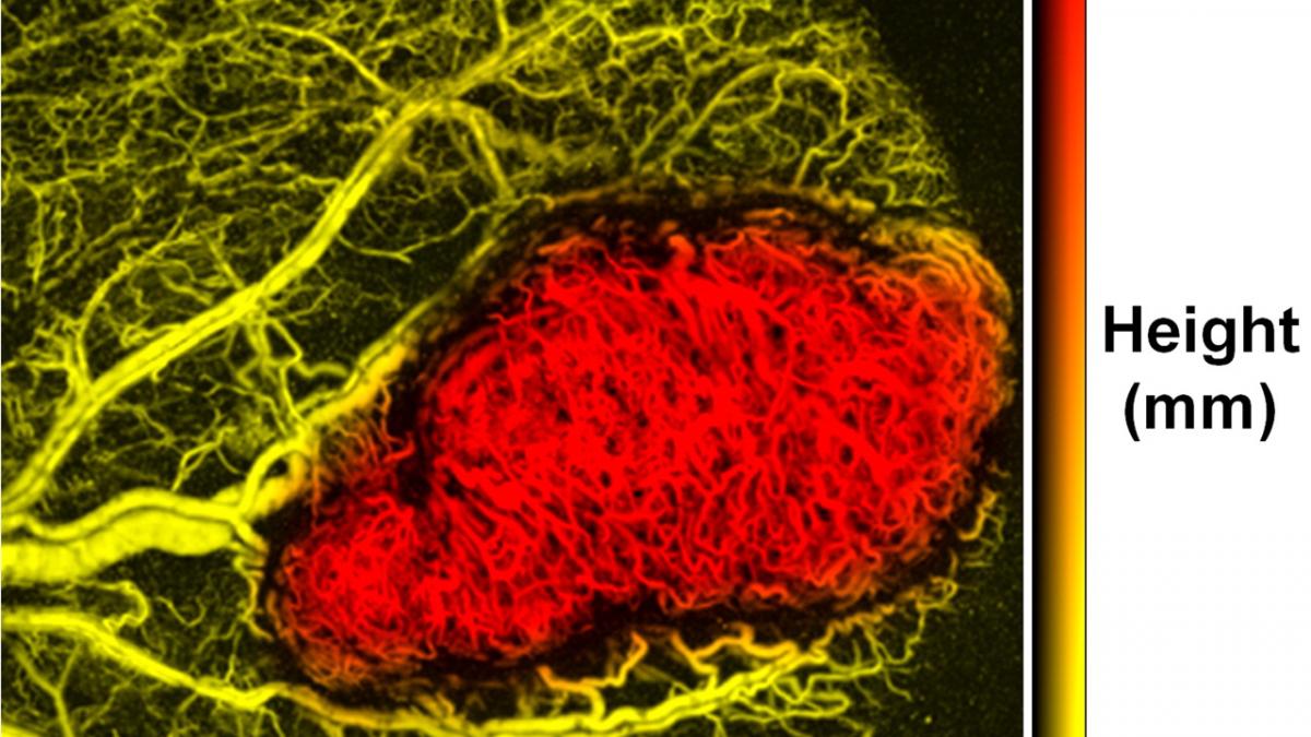 descoperirea care va revolutiona medicina din intreaga lume cancerul va putea fi depistat inainte