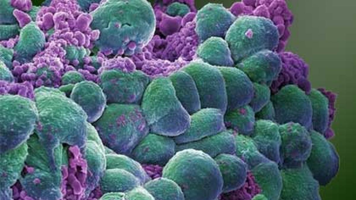 boala care a omorat milioane de femei poate fi depistata acum cu ajutorul unui test genetic