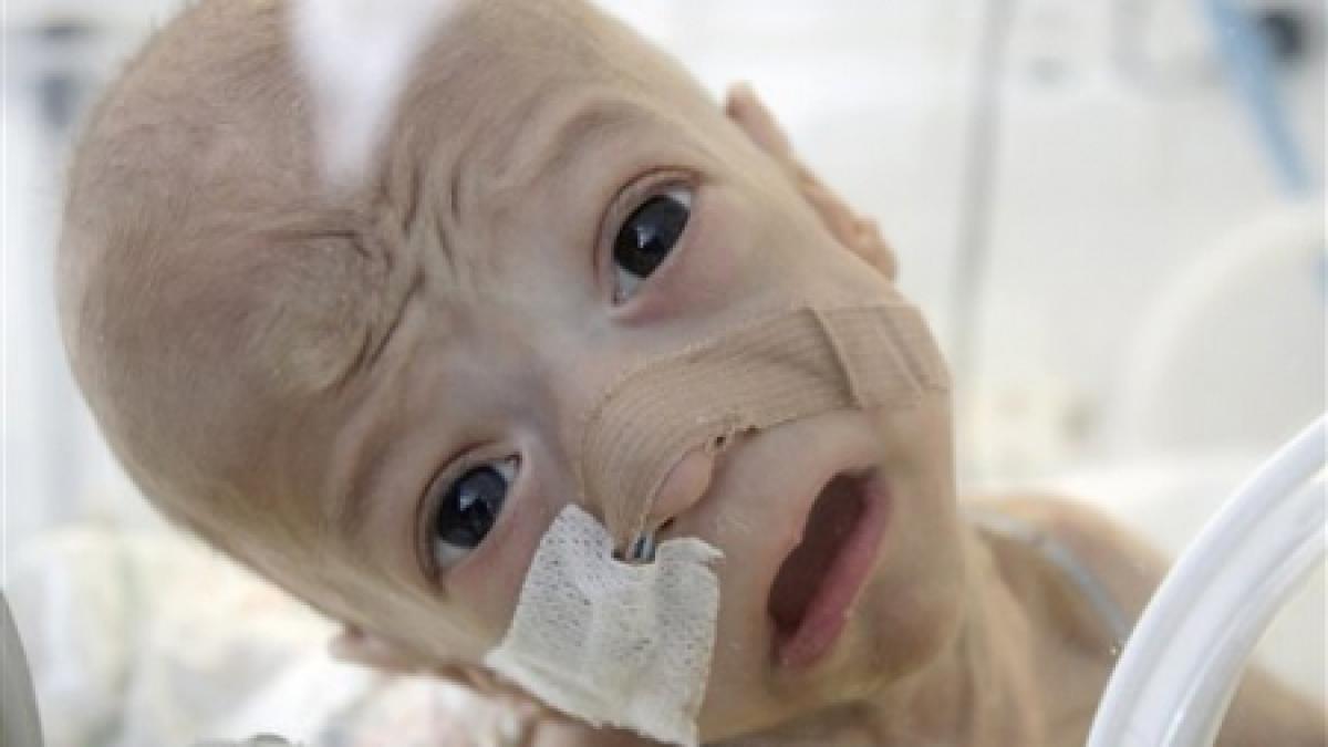 micutul andrei copilul nascut fara instestine a murit in urma operatiei