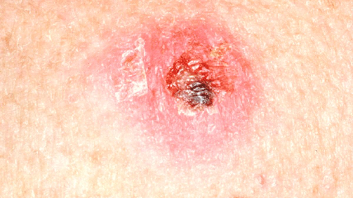 te poti imbolnavi de cancer de piele chiar daca nu stai la plaja vezi cum te poti feri