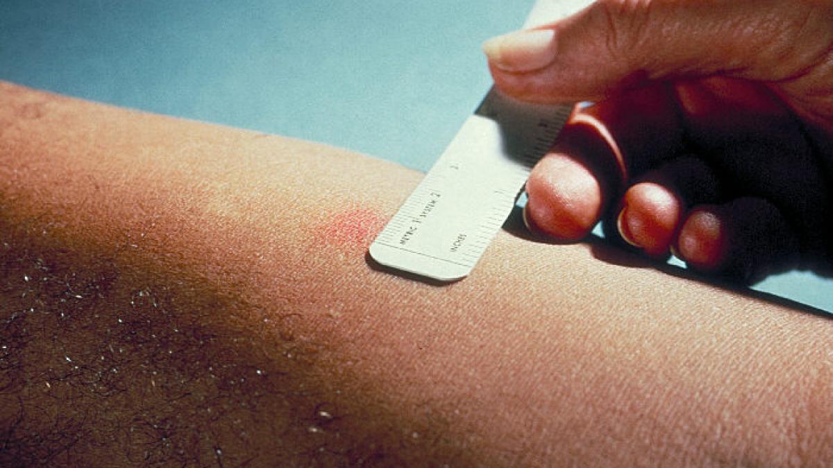 panica la gradinita 4 copii au reactionat pozitiv la testele tbc dupa ce educatoarea a venit bolnava