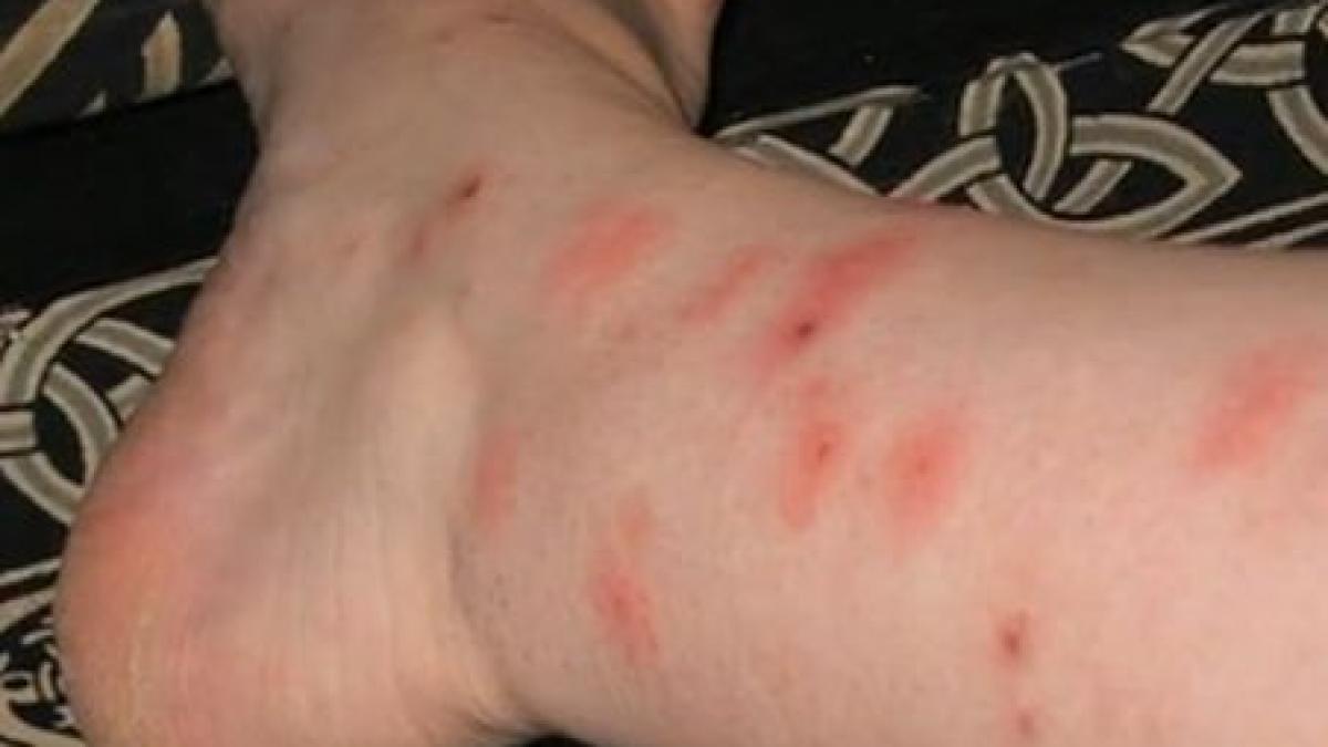 tantarii stresul verii au devenit dusmanul numarul unu al bucurestenilor