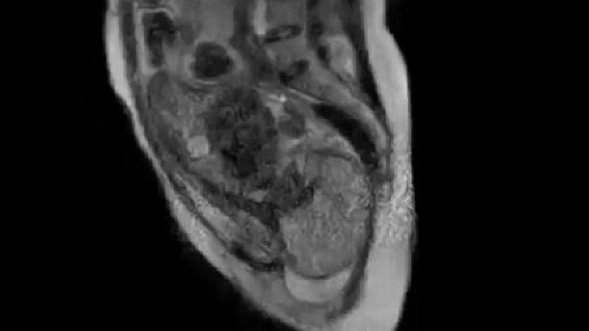 premiera mondiala in medicina inregistrare cu primul copil nascut intr un aparat rmn