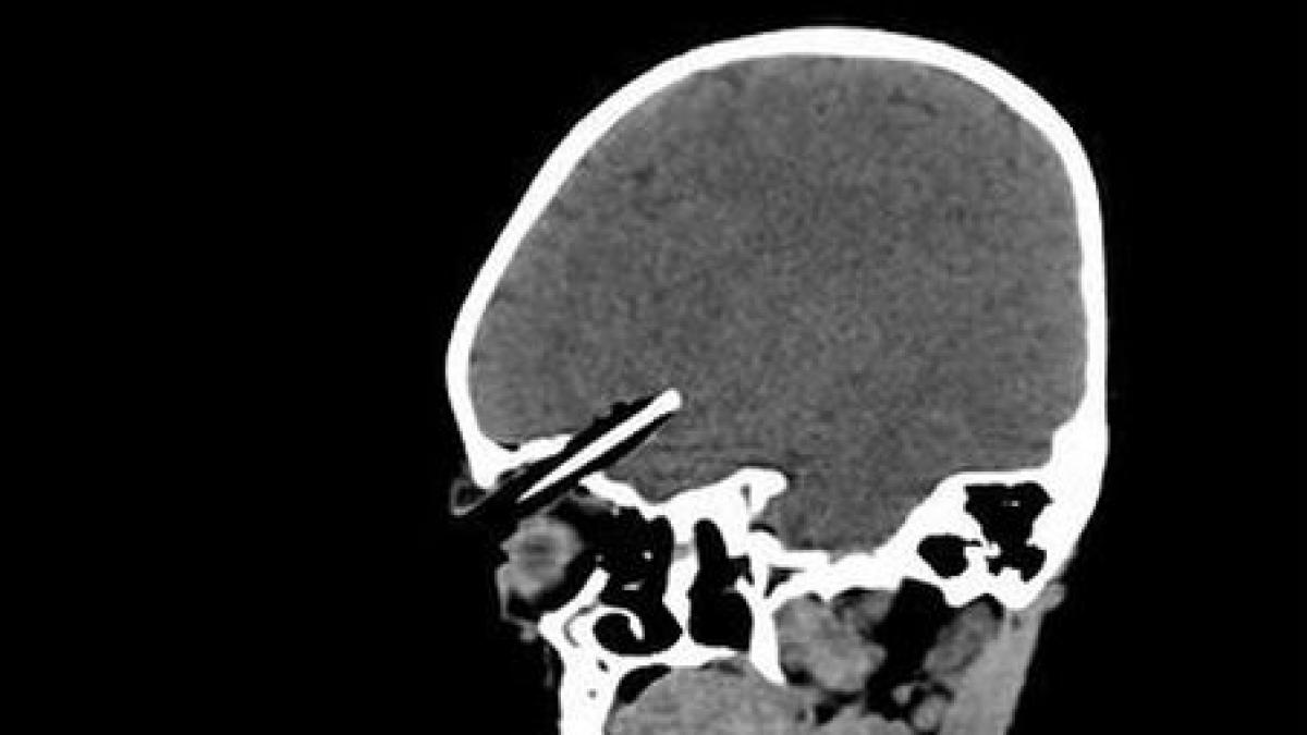 de la joaca la spital o fetita de doi ani cu un creion colorat infipt in creier salvata la timp de