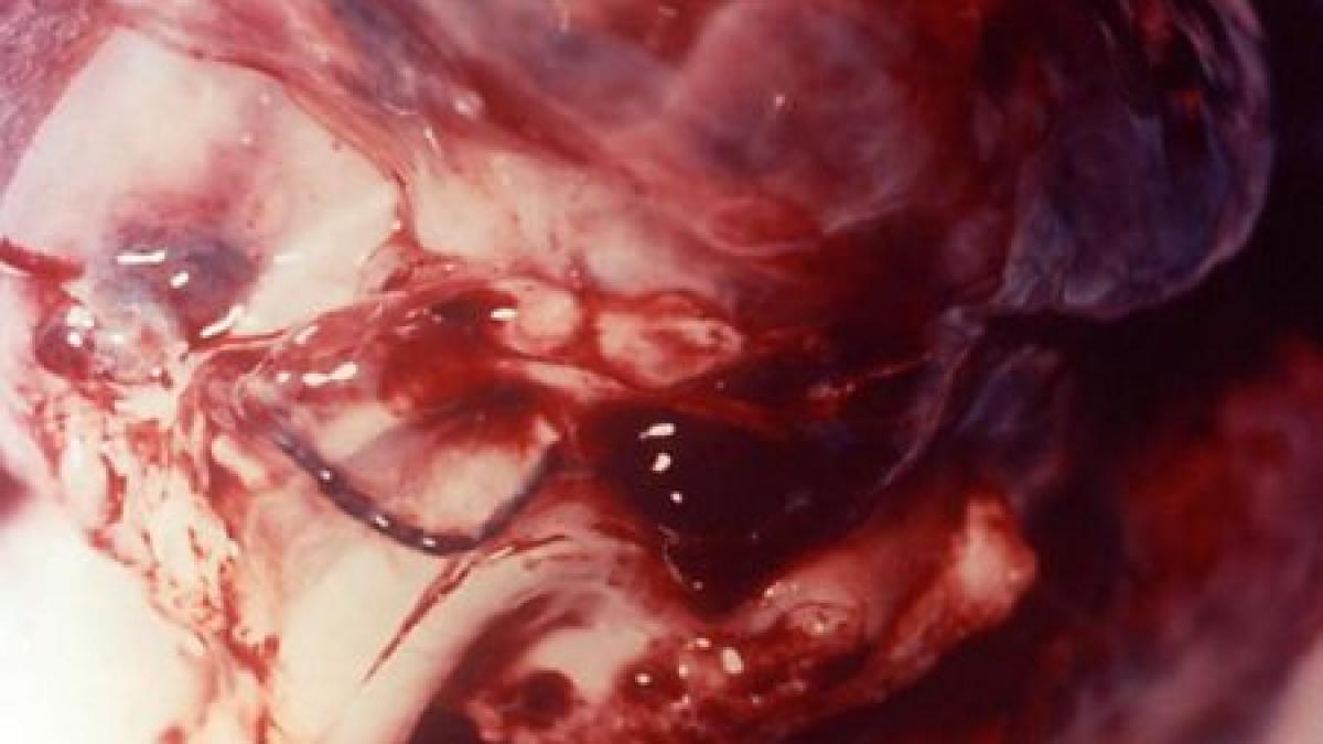 epidemie de antrax un om a murit si alti zece au ajuns in stare grava la spital