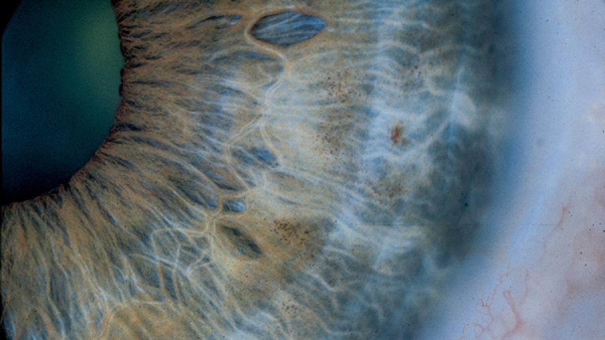 sanatatea se citeste in ochi iridologia ia amploare in romania