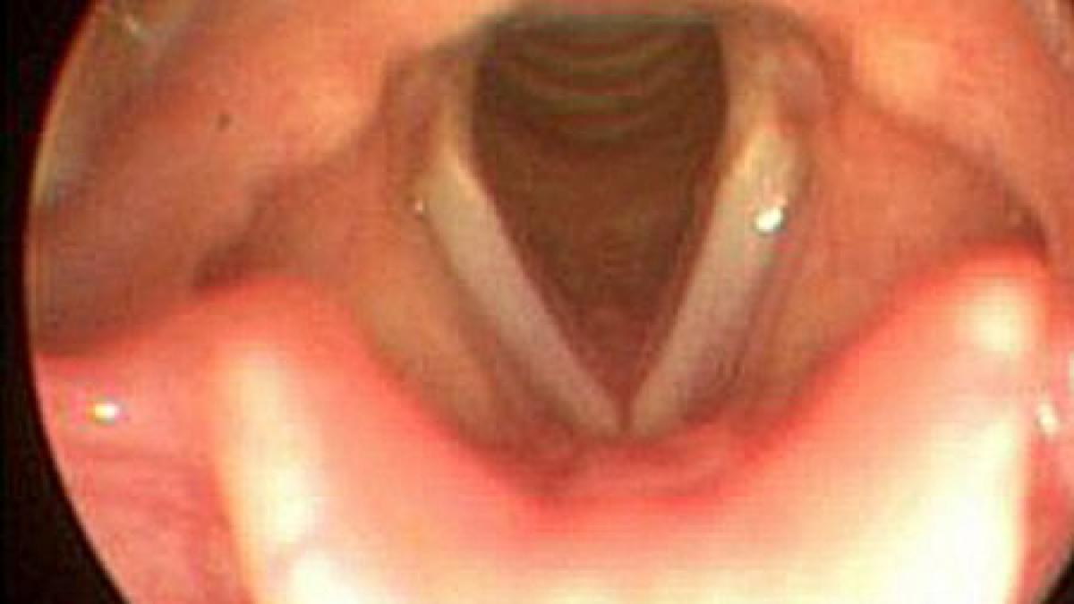 chirurgia estetica a vocii procedura medicala care iti intinereste corzile vocale