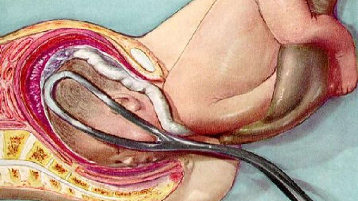 un bebelus a murit dupa ce medicii i ar fi strivit capul cu forcepsul