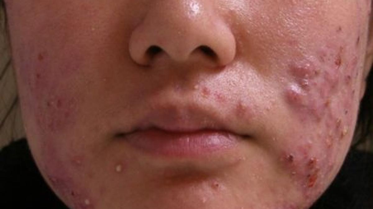 virusurile sterg acneea antibioticele ar putea deveni istorie