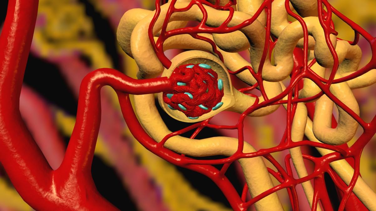 o metoda noua si eficienta de tratare a bolii care ucide milioane de oameni disponibila si in