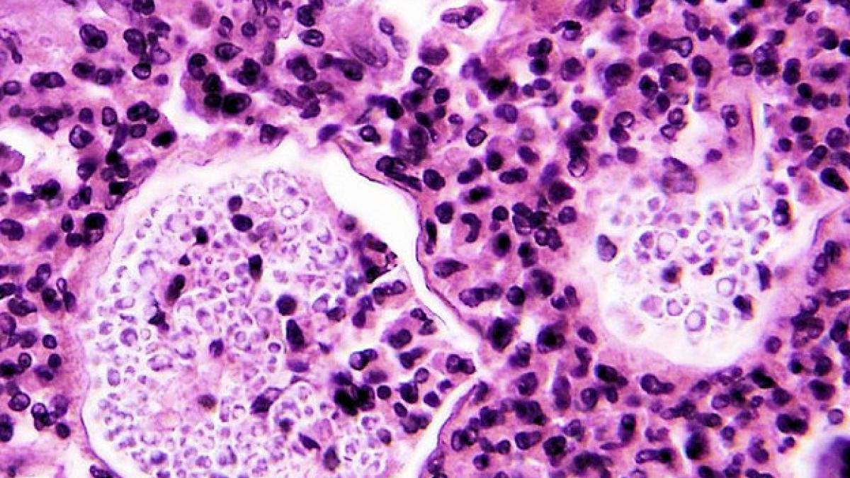 medicamentul care aduce boala americanii sunt speriati si se confrunta cu cea mai mare epidemie din