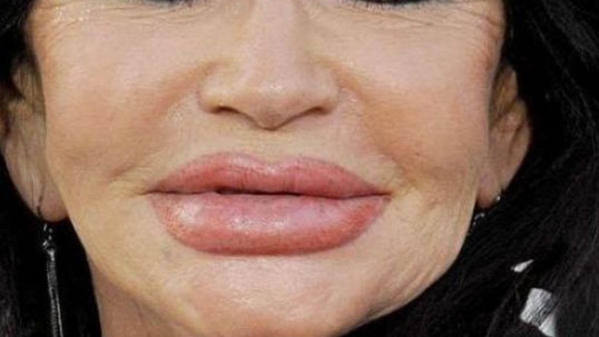 arata de parca i ar fi trecut trenul peste fata cand chirurgia estetica i a transformat in monstri