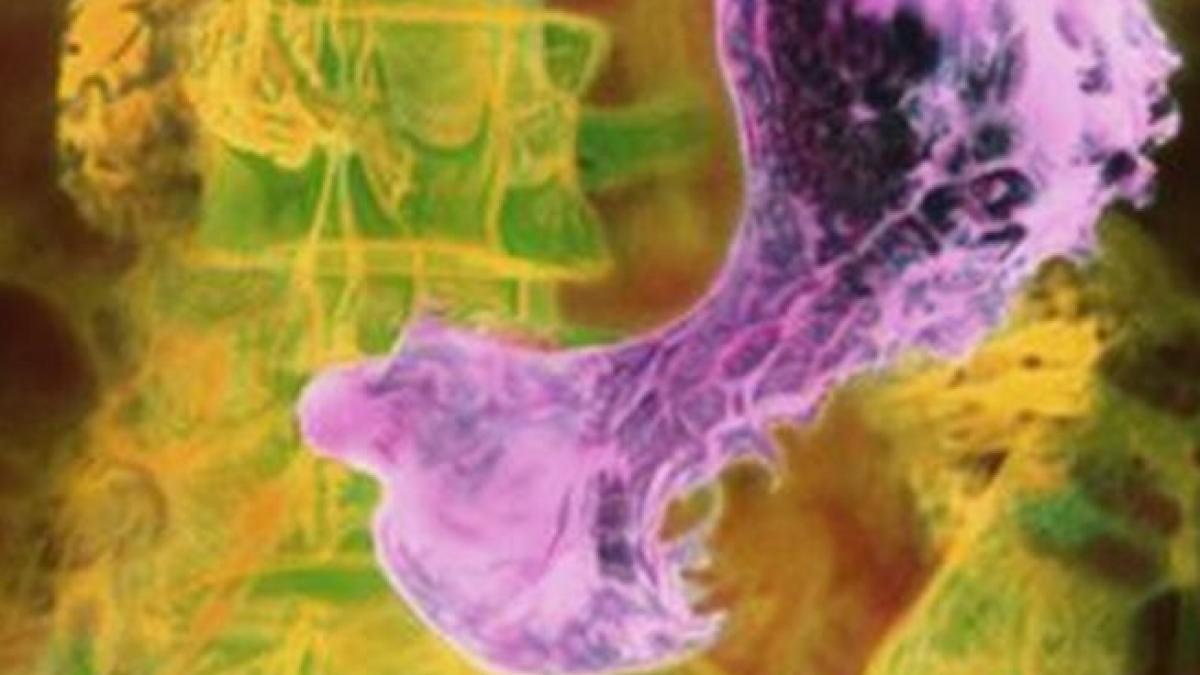 testul care ar putea revolutiona diagnosticarea cancerului de stomac ar putea salva milioane de
