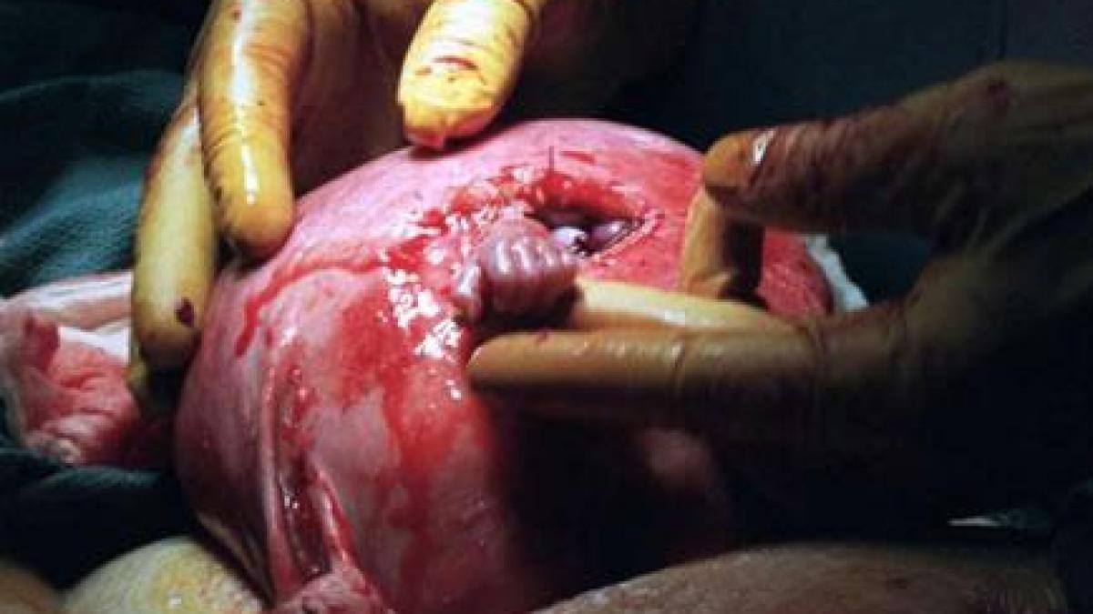 cum arata astazi copilul care s a prins de viata imaginea cu el in pantecele mamei a facut