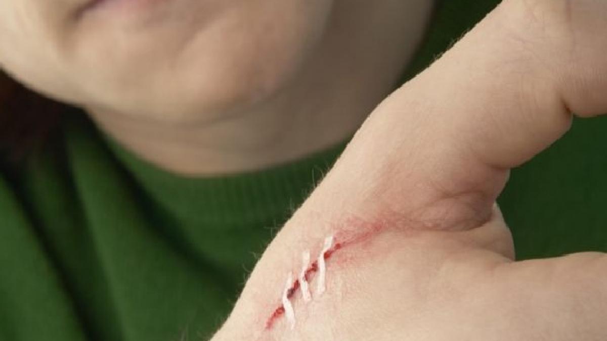 fara copci si fire tesuturile pot fi sudate cu laser