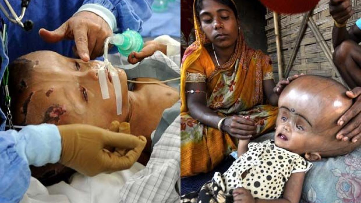 sansa la o viata normala fetita cu capul de extraterestru a fost operata cu succes in india