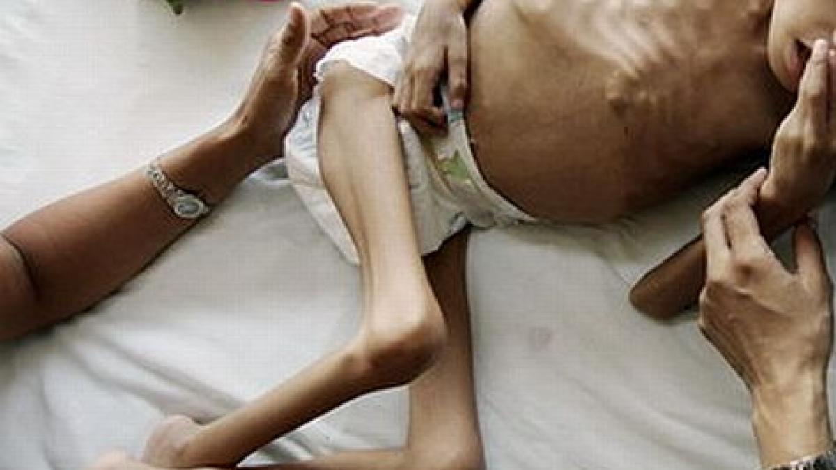caz terifiant de malnutritie severa un baiat de 7 ani cantareste doar 9 kilograme mai putin decat