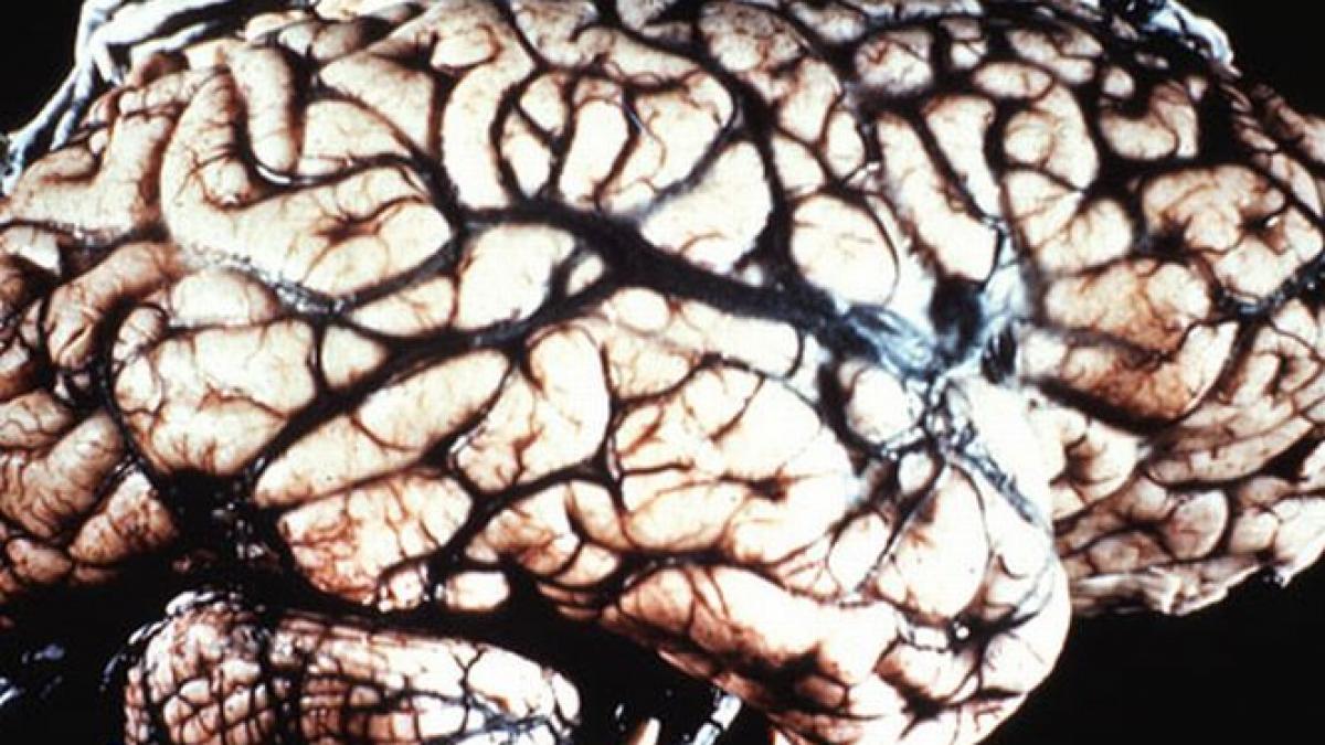 o boala extrem de rara a omorat un om in canada alte trei cazuri confirmate de medici